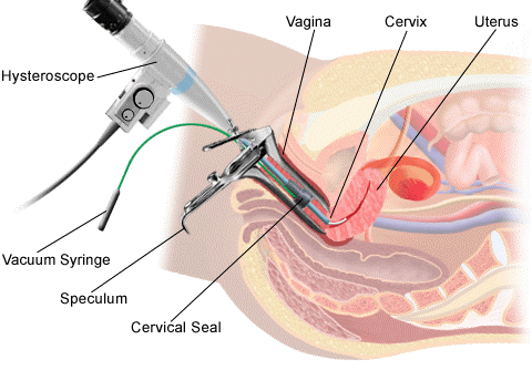 Hysteroscopic Tubal Cannulation Equipment