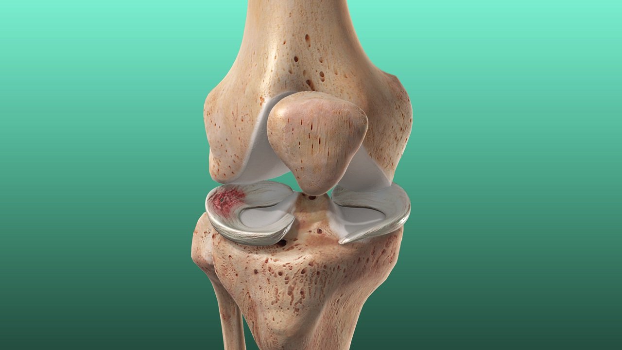 Meniscus Repair Treatment