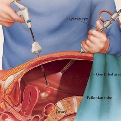 Laparoscopy Equipment