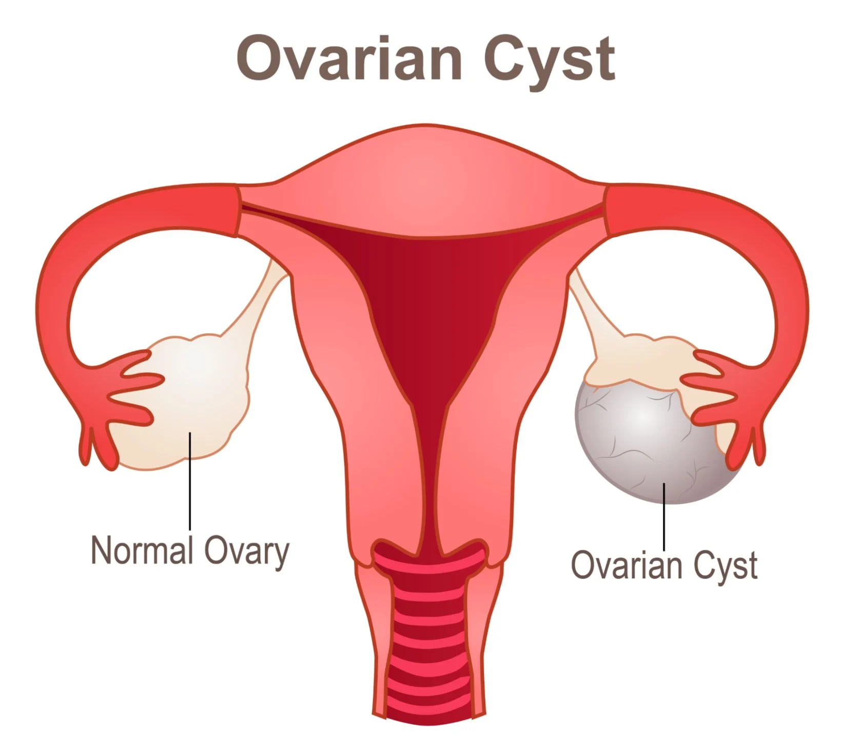 Ovarian Cystectomy Equipment
