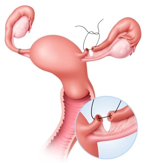 Tubal Recanalization Equipment