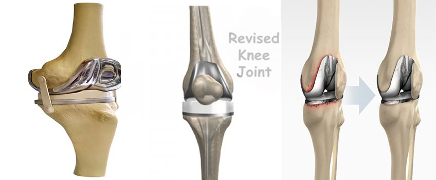 Knee Replacement