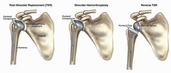 Partial Shoulder Replacement