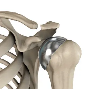 Partial Shoulder Replacement Equipment